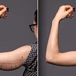 Achieve Toned and Sculpted Arms with Arm Lift Surgery
