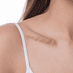 Methods of scar removal available with Webster, TX doctor