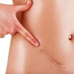 What methods of scar removal are available with Dr. Kimberly Carpin?