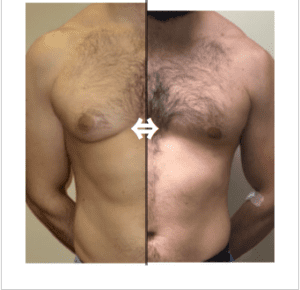 Gynecomastia Before & After Photo